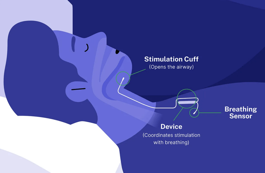 sleep apnea
